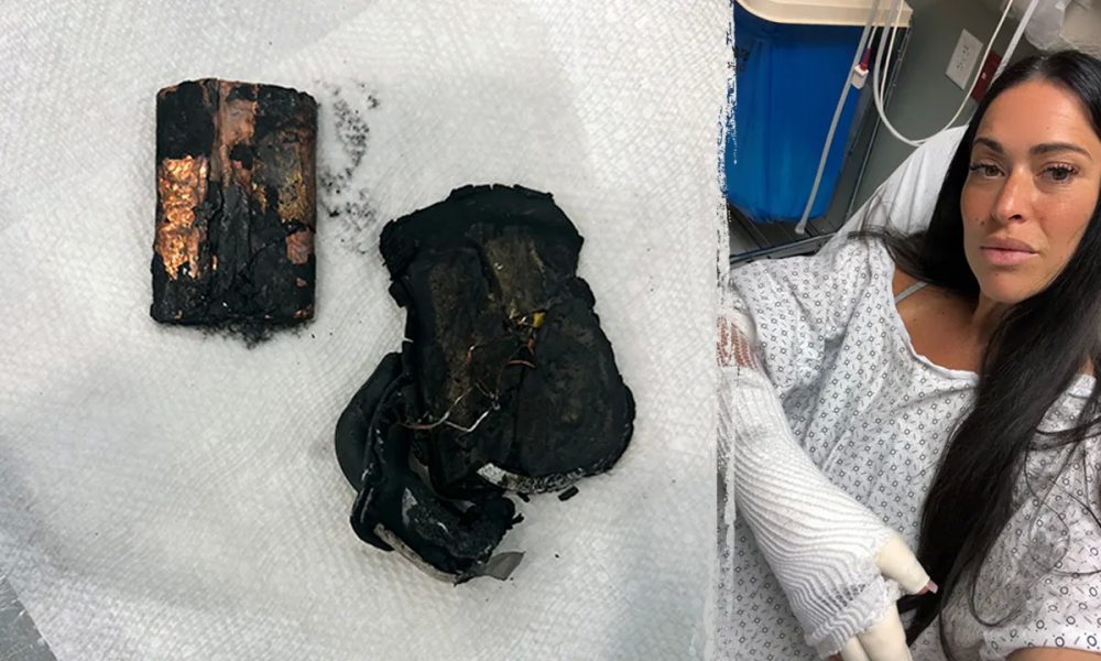 Portable charger explodes in bed, leaves woman with chemical burns