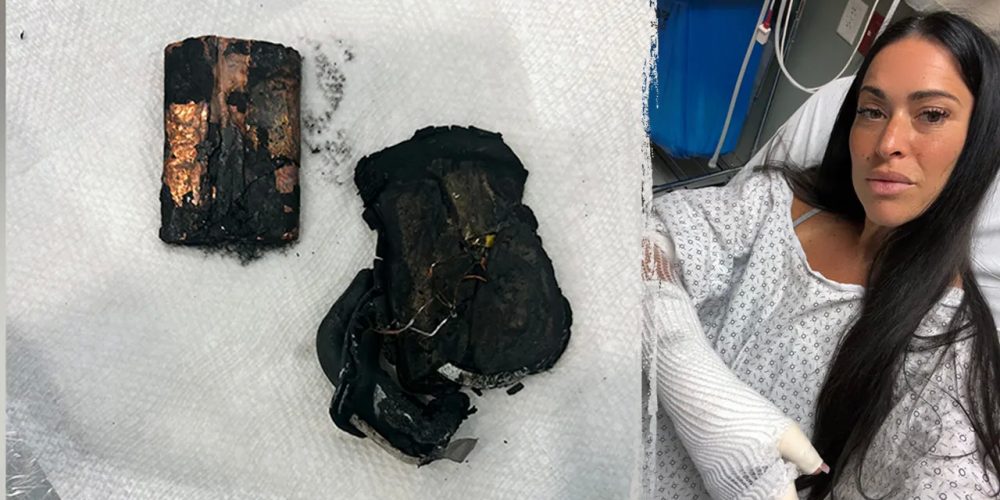 Portable charger explodes in bed, leaves woman with chemical burns